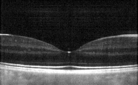 Die Makuladegeneration, abgekürzt AMD, ist eine Stoffwechselstörung im Auge, wodurch kleine Ablagerungen unter der Netzhaut entstehen und das Sichtfeld stark beeinträchtigen.